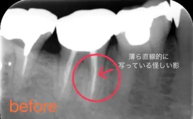 症例2:根管治療でリーマーが折れてしまった症例 術前