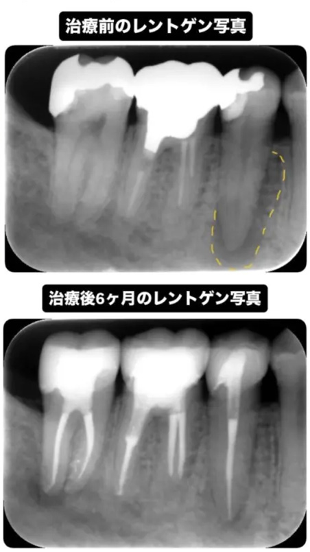 症例3:根管治療のビフォーアフターの画像