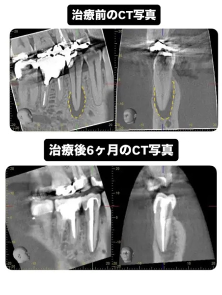 症例3:治療後半年の経過が確認できる