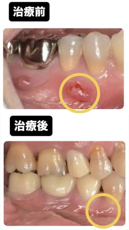 症例3:口腔内写真でフィステルがなくなっているのが確認できる