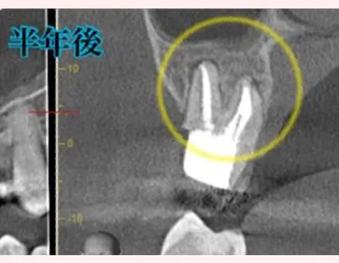 CASE1:治療後6ヶ月のデンタルレントゲン。MTAリペア後の骨回復(影の消失)が確認できる