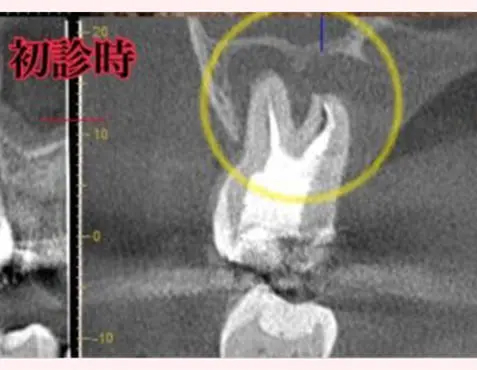 CASE1:治療前のデンタルレントゲン。根尖病変(骨が溶けた影)が確認できる