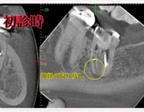 CASE1処置内容:補綴物除去後の口腔内写真(治療開始前)