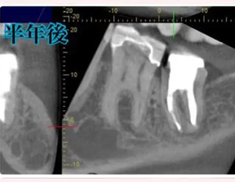 CASE1処置内容:治療完了後のオールセラミックス補綴物(術後)