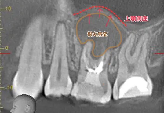 CASE2初診時:根尖病変治療前のデンタルレントゲン。重度の骨吸収が確認できる