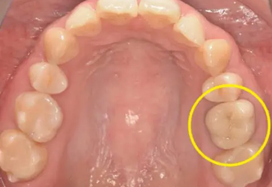 CASE2処置後:根管治療後に装着された補綴物の写真