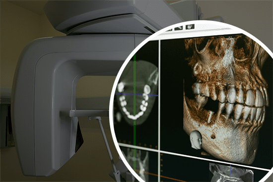 歯科用CTによる歯根の三次元解析データ画像