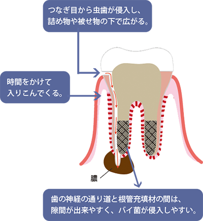 根管に細菌の侵入経路を図で示し膿ができるのが分かる図
