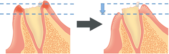 歯冠長延長術(APF)の図解。歯茎の下に埋もれた歯を露出させる手術