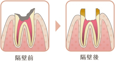 隔壁の図解。小さくなった歯にレジンで壁を作り、ラバーダム装着を可能にする