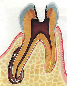 再治療の原因:根管内部に感染物質が残っている状態の図解