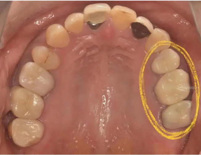 症例4:他院で抜歯と言われた歯を保存する治療 術後