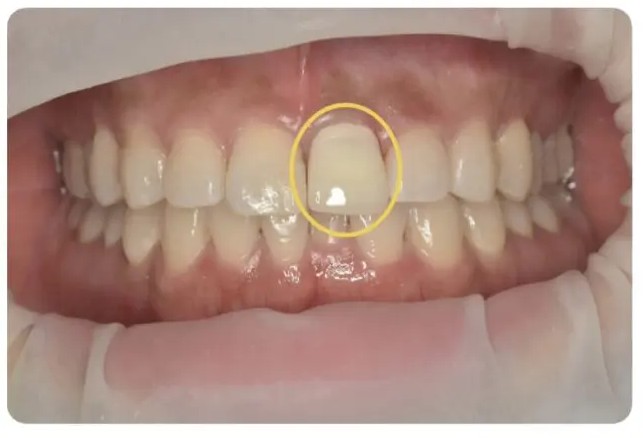 症例5:神経の取り残しで前歯が黒ずんでしまった患者様の症例 術後