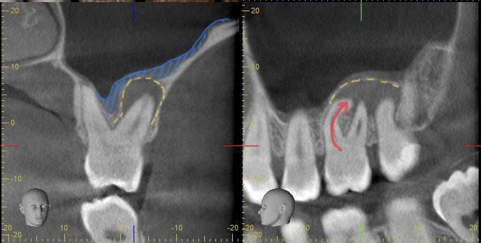 症例7:根の先に大きな病変(根尖病変)が確認できるレントゲン