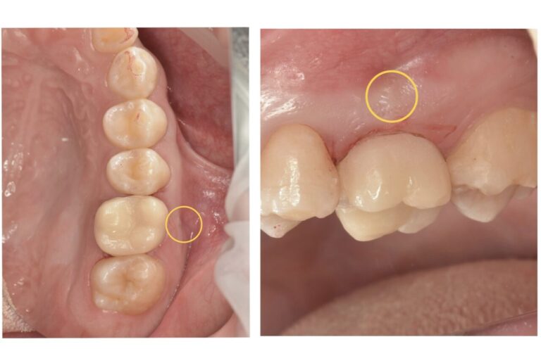 症例7:根管治療後、腫れていた歯茎が消えた後の口腔内写真