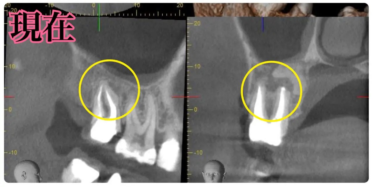 症例6:他院で治療を繰り返していた患者様の症例 術後