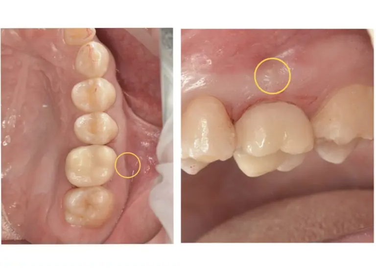 症例7:数年前に虫歯治療をした歯の歯茎が腫れたという患者様の症例 術後
