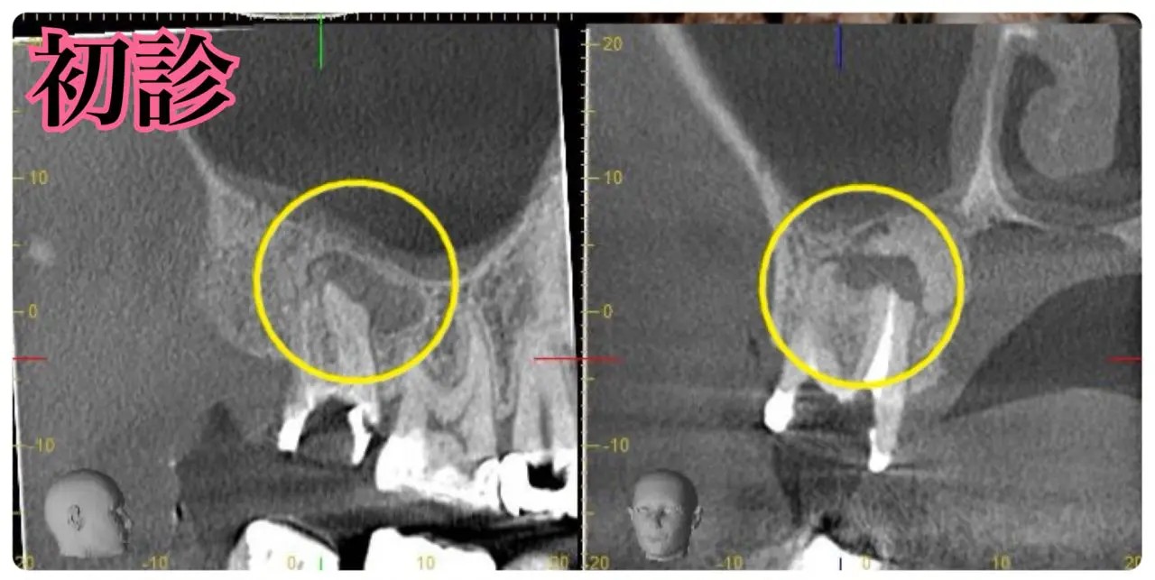 症例6:他院で治療を繰り返していた患者様の症例 術前