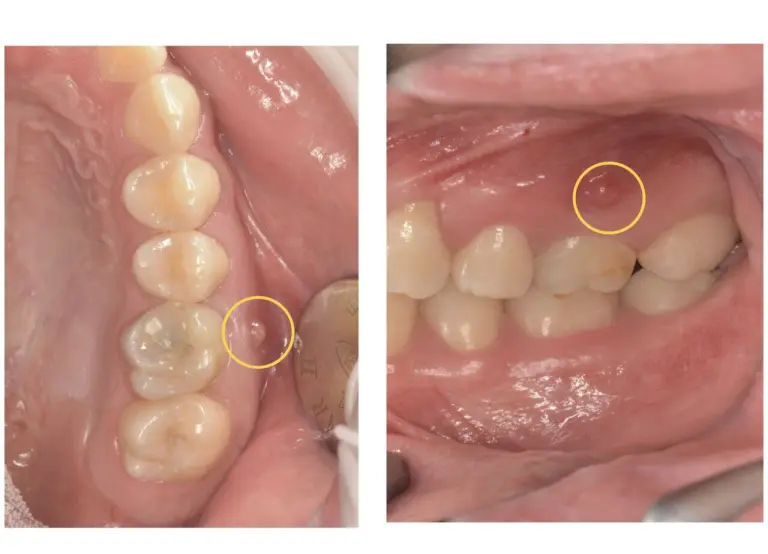 症例7:数年前に虫歯治療をした歯の歯茎が腫れたという患者様の症例 術前