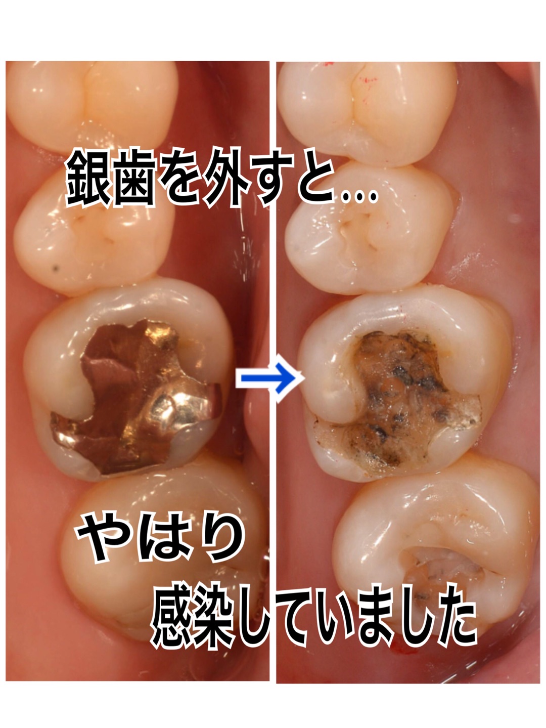 銀歯の下は… | 天王寺の歯医者（歯科医院）『松川デンタルオフィス』