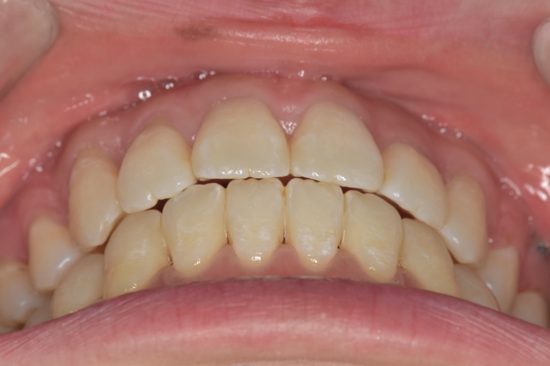 前歯 隣 の 歯